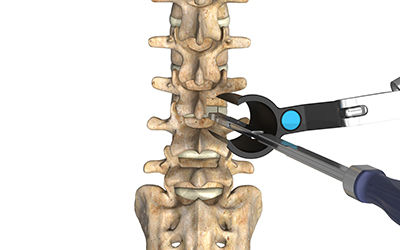 Spinal access and decompression | Stryker